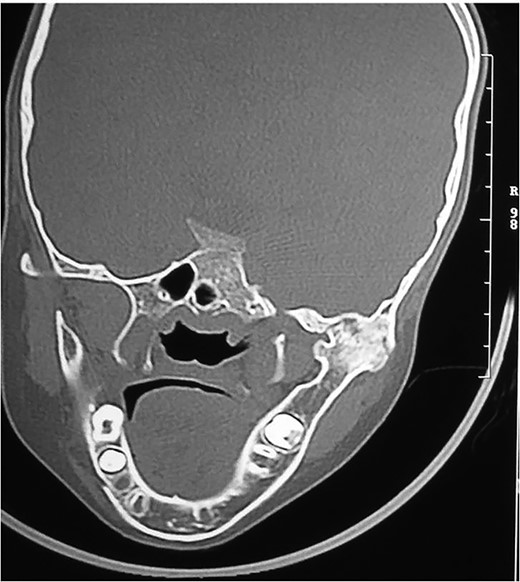 Right side bony ankylosis in coronal section CT.