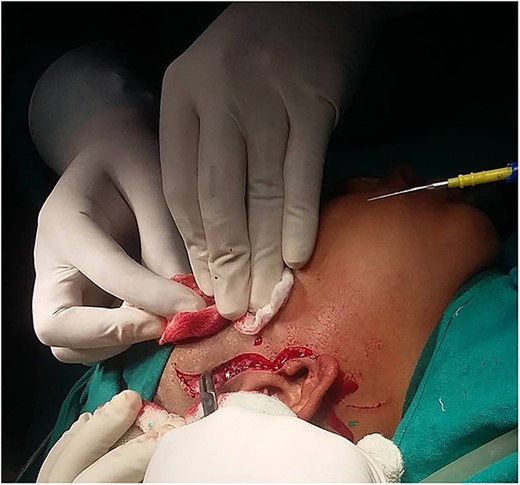 Alkyalam Briyam incision.