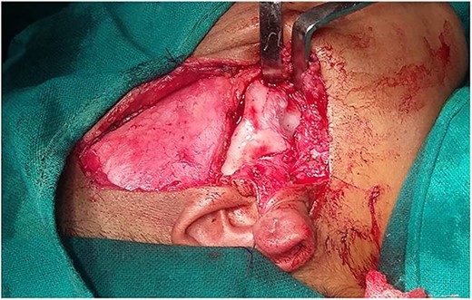 Ankylotic mass.