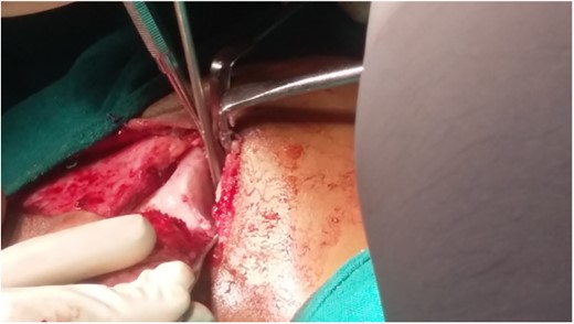 Separation of condylar unit from skull base.