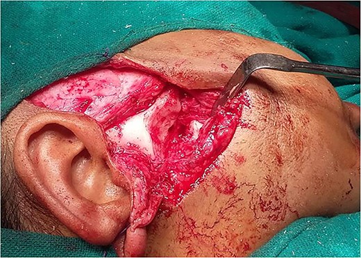 Gap arthroplasty.