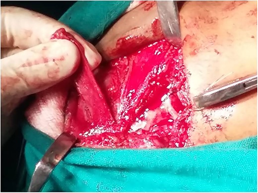 Temporalis myofascial flap for interpositional gap arthroplasty.