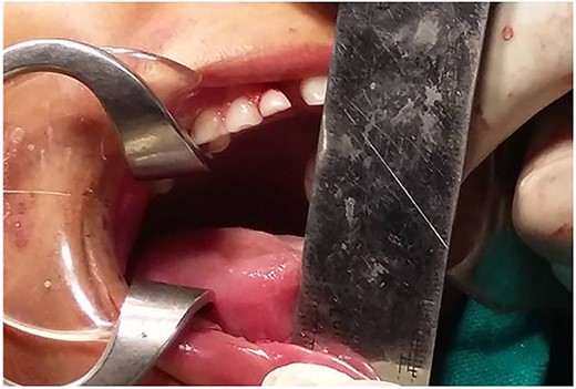 Immediate post-operative clinical picture.