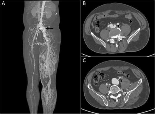 CTA showing AVF between the right internal iliac artery and the left common iliac vein. (A) The left common iliac vein and dilated tortuous veins in the left lower limb; (B, C) An AVF (black arrow) between the right internal iliac artery and the left common iliac vein.
