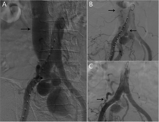 (A) AVF and inferior vena cava can be seen in the angiography; (B) one covered stent graft was implanted at the right common iliac artery; angiography demonstrated that the contrast can pass into the inferior vena cava; (C) after the lumbar artery was embolized by coils, inferior vena cava was no longer enhanced.
