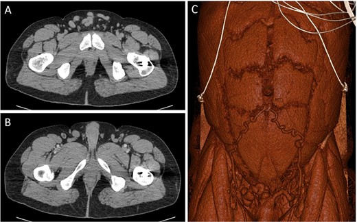 CT images through the pelvis show the dilated collateral veins (A) in the suprapubic region, initially thought to be a hernia. Solid white arrows (B) show the external pudendal vein confluences with the great saphenous veins. 3D reconstructed image (C) shows the dilated inferior epigastric and external pudendal veins, providing collateral flow around the stenosed left iliofemoral venous system.