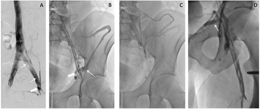 Iliocaval venogram (A) shows post-thrombotic changes including stenosis (thick white arrow) and synechiae (thin white arrows). Left external to common iliac venogram (B) shows collateral drainage pathway via the inferior epigastric vein (thick white arrow) to the contralateral external iliac vein and via the iliac circumflex (thin white arrow). Continued drainage (C) from the iliac circumflex into the iliolumbar and hemiazygos veins is shown. Saphenofemoral venogram (D) shows the sapheno-saphenous collateral drainage occurring via the external pudendal vein (thin white arrow).