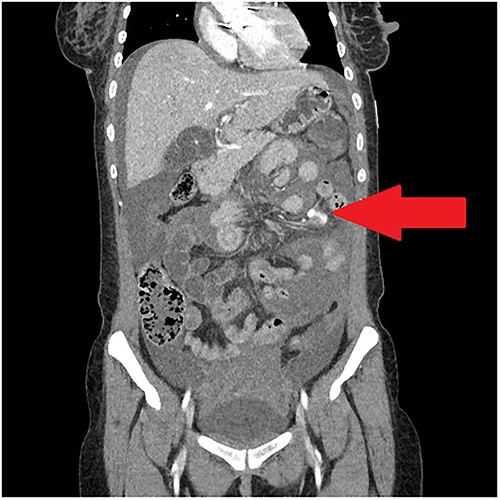 Portal-venous phase CT abdomen demonstrating haemoperitoneum and contrast extravasation in small bowel mesentery.