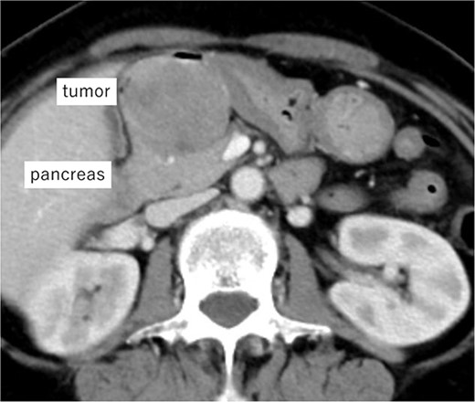 Imaging of the tumor. Contrast-enhanced CT showing a 5 cm large mass with contrast effect on the posterior wall of the duodenal bulb and pancreatic head invasion.