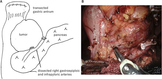 Operative findings. (A) Surgical schema. The large tumor was located at the posterior wall of the duodenal bulb and buried in the pancreatic head. Gastric antrum was transected and inverted to the right side. (B) Ventral side of the tumor. The prominent part of the pancreatic head was tightly adherent to the tumor. However, the prominent part could be dissected from the tumor by precise manipulation of robotic bipolar Maryland’s forceps.