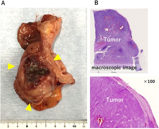 The resected specimen. (A) 5.0 × 4.2 × 4.1 cm solid tumor with ulceration was observed in the duodenal bulb. (B) Histologically, the tumor capsule was confirmed to be preserved.
