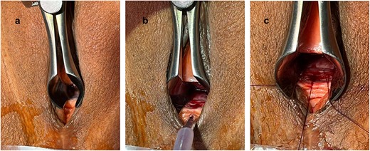Exposure of the urethral stricture using a nasal speculum (a); after urethrotomy at 6 o’clock (b); prepared 5-0 PDS sutures at 5, 6 and 7 o’clock (c).