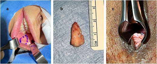 Planning of buccal mucosal graft harvesting (a); harvested buccal mucosal graft (b); after complete fixation of the graft (c).