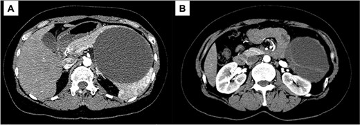 Contrast-enhanced CT; (A) the large cystic lesion in the pancreatic tail has displaced the stomach and the body of the pancreas; (B) the wall and septum show enhancement.