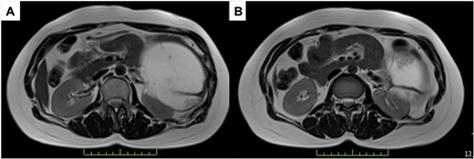 T2-weighted MRI; (A) the tumor has a thick fibrous capsule; (B) the tumor has a thick fibrous septum.