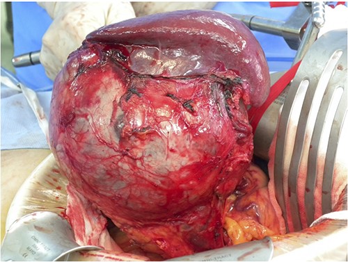 Intraoperative findings; a 15-cm tumor is identified in the tail of the pancreas, adherent to the spleen; distal pancreatectomy with splenectomy was performed.