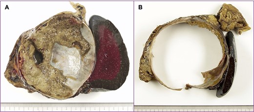 A cut surface of the tumor; (A) the tumor included necrosis tissue and septum; (B) the cystic wall was thick.
