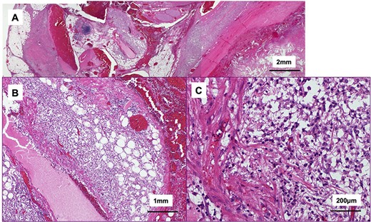 Histological findings of the tumor (hematoxylin and eosin stain); (A) the tumor included bled, necrosis tissue and cholesterin crystal; the cystic wall compromised collagenous, fibrous tissue; (B, C) eosinophilic necrosis and accumulated macrophages in fat outside the cystic wall.