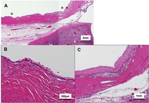 Histological findings of the cystic wall (hematoxylin and eosin stain); (A) ~95% of overlying cystic walls lacked apparent epithelium; (B) magnified view from * area in (A); ~5% of the cyst wall was covered with monolayered mucin-producing, goblet-like cells lacking high grade atypia; (C) magnified view from ** are in (A); ~95% of the cyst wall was covered with fibrous tissue surrounded by inflammatory cells.
