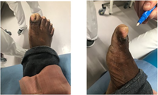 Initial lesion of the great toe.