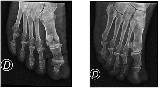Foot X-ray showing no bone involvement.