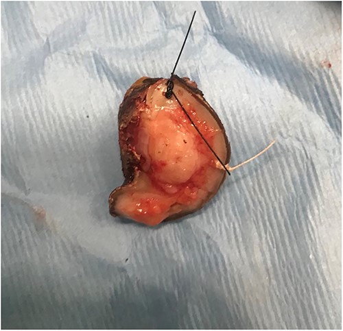 Excision of the lesion.