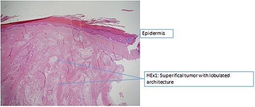 Histopathology – superficial tumour with lobulated architecture.