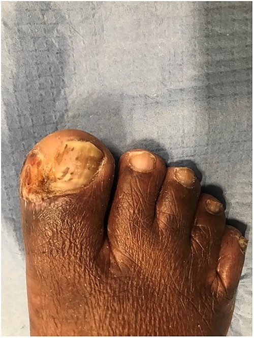 Aspect of the great toe at the 6-month follow-up.