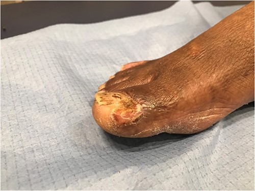 Aspect of the great toe at the 6-month follow-up.