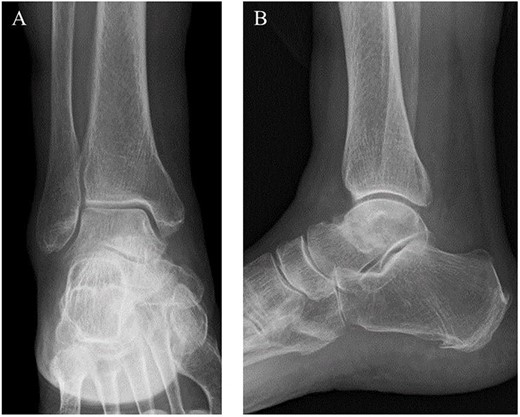 Preoperative plain radiographs showed no obvious abnormal findings from the (A) anteroposterior and (B) lateral views.