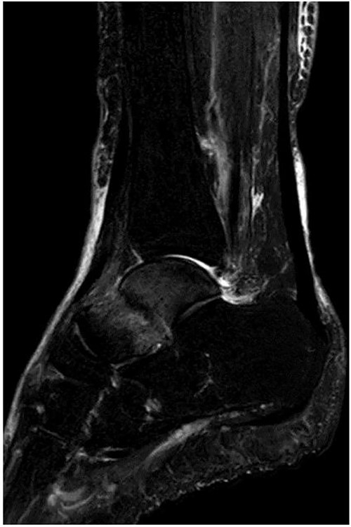 MRI revealed a low signal linear line in the talar neck and a bone marrow edema around the line on a fat-suppressed T2-weighted (FS-T2) image.