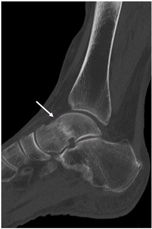 Although a non-contrast CT scan of the sagittal view demonstrated a fracture line in the talar neck (arrow), the bone fragment was not dislocated.