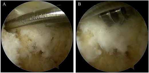 (A) After confirming the posterior part of the talar body and the FHL, two 1.6-mm diameter guidewires were parallelly inserted from the posterior part of the talar body to the talar head via under hindfoot endoscopy and fluoroscopy; (B) two cannulated, 4.5-mm diameter double-threaded screws were inserted through the guidewires.