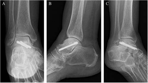 Post-operative plain radiographs revealed that two cannulated 4.5-mm double-threaded screws were inserted from the posterior part of the talus to the talar head as seen from the (A) anteroposterior, (B) lateral and (C) oblique views.