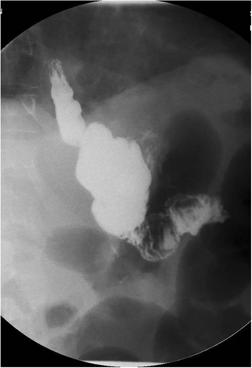 Small bowel series showing normal contrast transit from esophagus to stomach to small bowel loop.