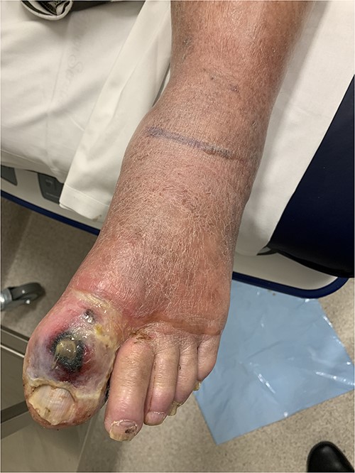 Clinical photography of the left foot of Case 1 at time of surgical referral.
