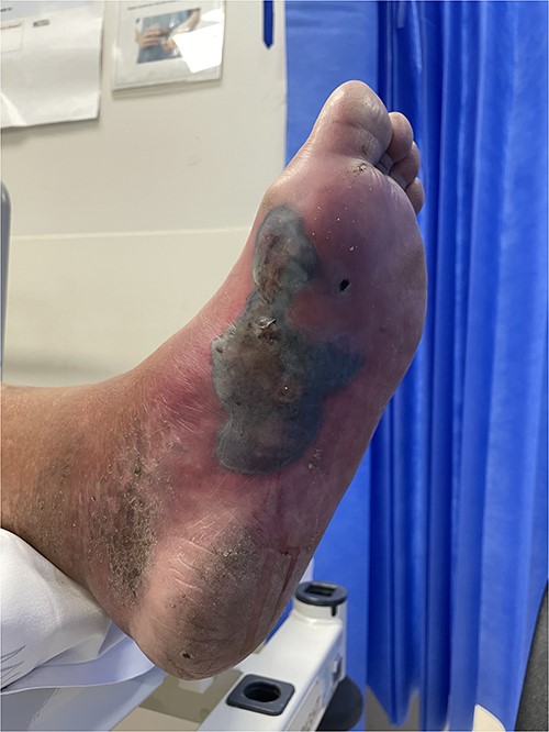 Clinical photography of the left foot of Case 2 at time of surgical referral.