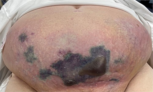 Clinical photography of the abdominal wall of Case 3 at time of surgical referral and intra-operatively.