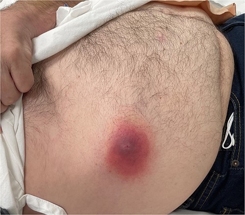 Clinical photography of the abdominal wall of Case 4 at time of surgical referral.