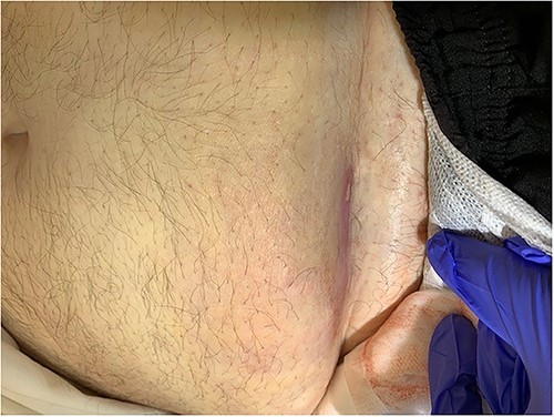 Clinical photography of the abdominal wall of Case 5 at time of surgical referral.