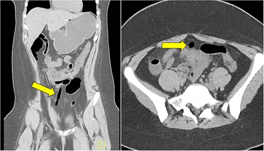 CT scan of abdomen and pelvis showing the presence of an air-filled foreign body in coronal and axial view.