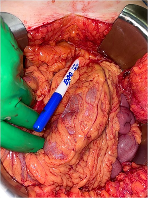 A marking pen was found within the mid-upper abdomen within the greater omentum in parallel to the transverse colon.