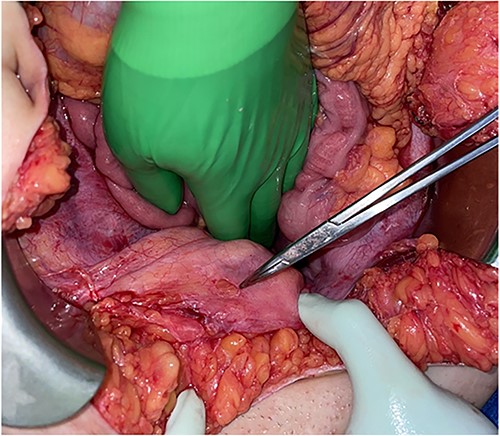 Round defect in the dome of the bladder (pointed with the tip of Tonsil Forceps).