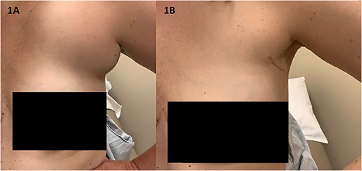 (A) The patient’s axilla on initial presentation had significant swelling and tenderness without overlying erythema or other skin changes (B) the patient’s axilla at her 2-month post-operative visit demonstrates her well-healed surgical scar and decreased fullness to the area.