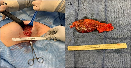 (A) Intra-operatively, the mass was lobular in nature and was noted to extend to the axillary vein; (B) the mass measured over 10 cm in its longest diameter once fully excised.