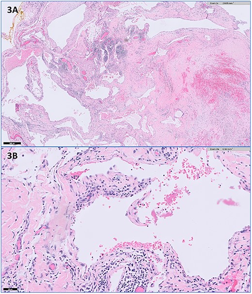 Representative histopathologic images of the vascular malformation with hematoxylin and eosin stain showing ectatic vessels with luminal red blood cells and lined by flattened endothelial cells at (A) 2× magnification and (B) 20× magnification.