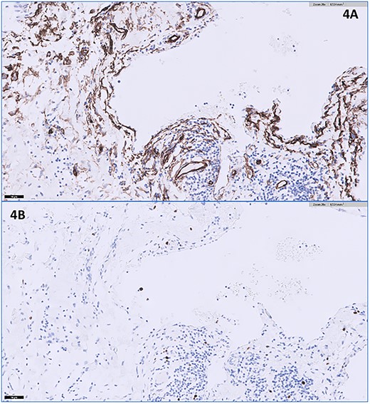 (A) The CD34 immunohistochemical stain appears positive lining the endothelial cells (20× magnification); (B) the Ki-67 immunohistochemical stain shows a very low proliferation index in lining endothelial cells at <1% (20× magnification).