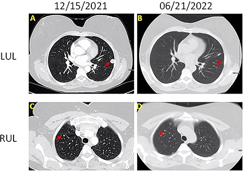 Chest CT images of the lesions (A) left upper lobe lesion (1.5 cm) before surgery on 15 December 2021; (B) left upper lobe lesion after surgery on 21 June 2022; (C) right upper lobe lesion (0.5 cm) on 15 December 2021; (B) right upper lobe lesion on 21 June 2022; there is no change on the size.
