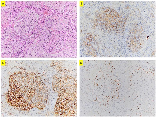 (A) H&E section (200×) shows whorls formation and pseudo-nuclear inclusions; tumor cells are positive for EMA (B), SSTR2a (C) and PR (D) (200×).