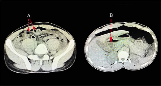 CT scan images pointing out presence of pneumoperitoneum related to a perforation (A), with free fluid collection in the abdomen (B).